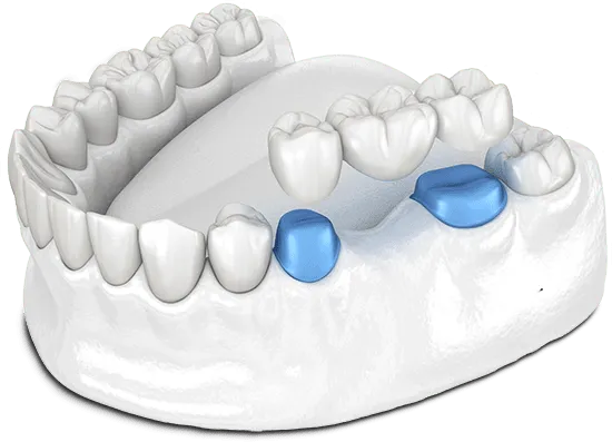 dental-bridge-model.png