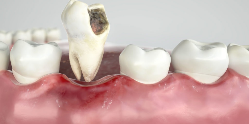 tooth-decay-graphic-3-1024x512.jpg