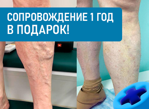 Лазерное лечение варикозных вен